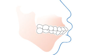 双颌前突