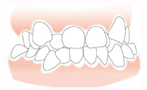 牙齿拥挤